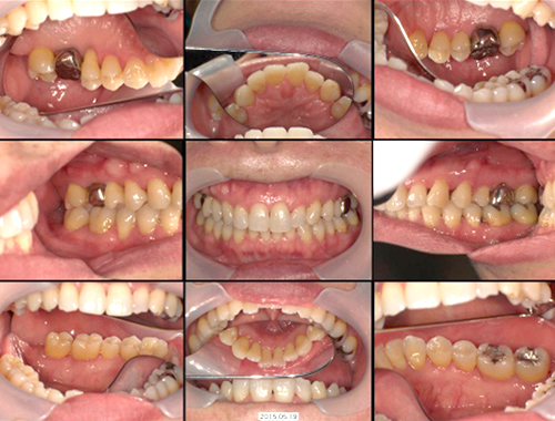 歯周内科治療前