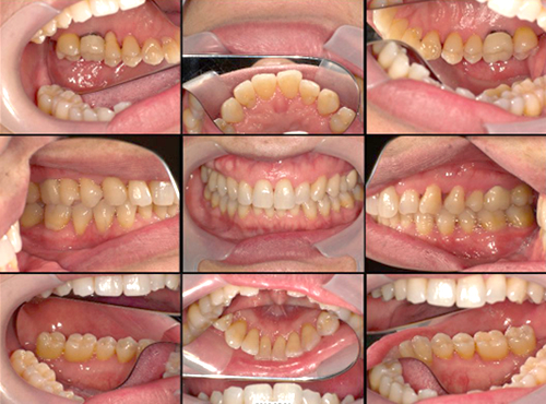 歯周内科治療後